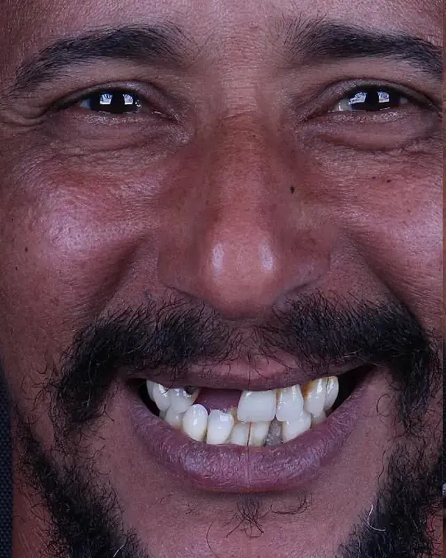 Antes: sorriso de paciente reabilitado
