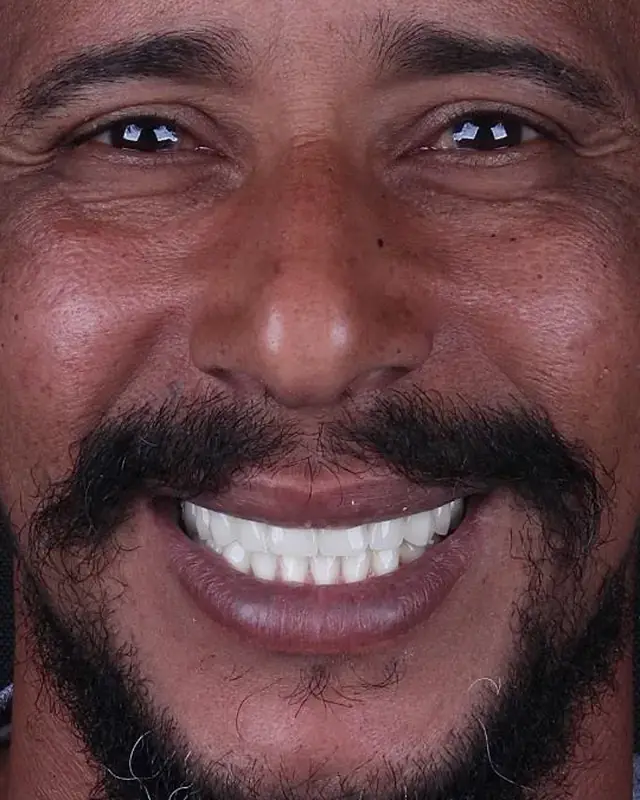 Depois: sorriso de paciente reabilitado