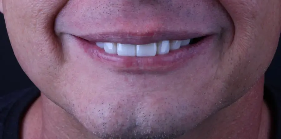Depois: sorriso de paciente com lentes de contato dental