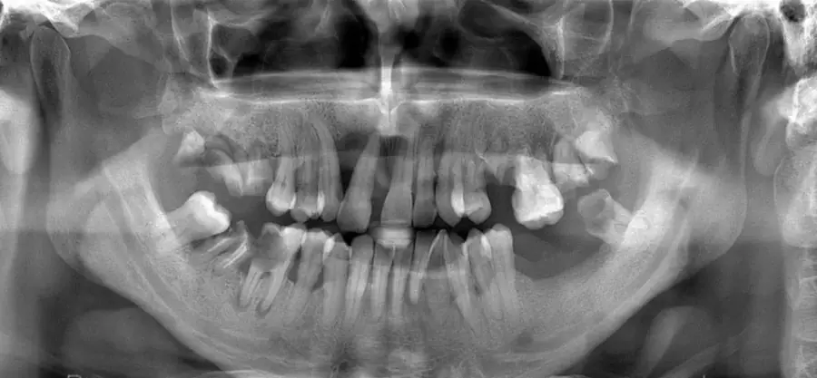 Antes: radiografia antes e depois do protocolo sobre implantes