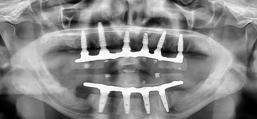 Depois: radiografia antes e depois do protocolo sobre implantes