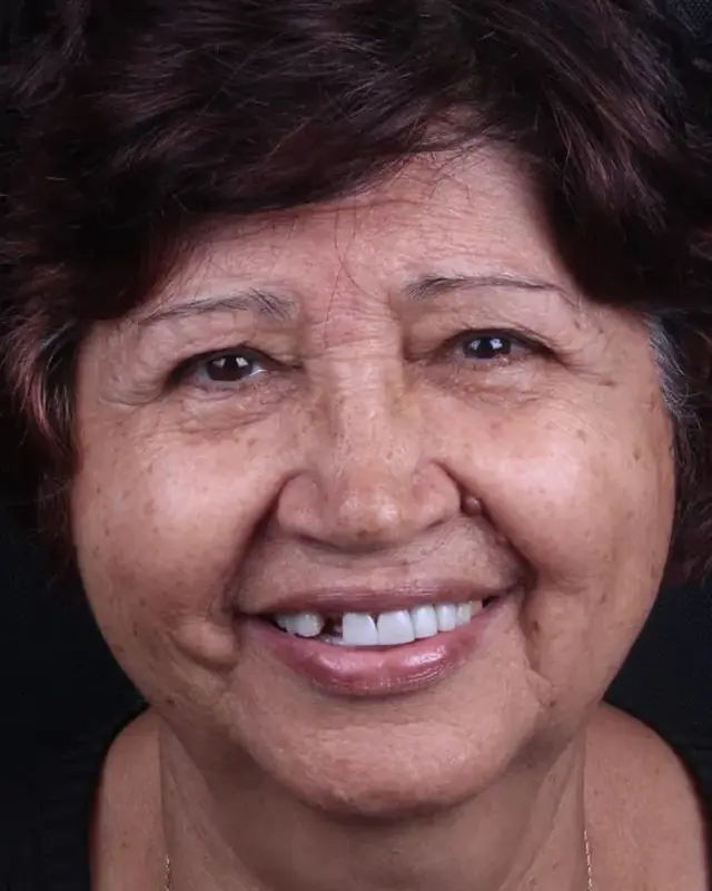 Antes: sorriso de paciente após repor o dente da frente